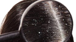 Dandruff Remedies: ತಲೆಹೊಟ್ಟಿನ ಸಮಸ್ಯೆ ನಿವಾರಿಸಲು ಇಲ್ಲಿದೆ ಸಿಂಪಲ್ ಟಿಪ್ಸ್