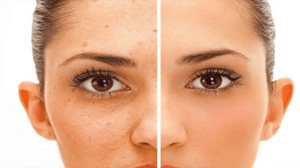 Here is the easy tips to remove dark spots on Face ಮುಖದ ಮೇಲಿನ