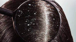 Dandruff Solution: ತಲೆಹಿಟ್ಟಿನ ಸಮಸ್ಯೆಯೇ..? ಇಲ್ಲಿದೆ ಶಾಶ್ವತ ಪರಿಹಾರ