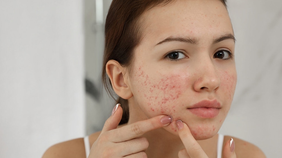 try-this-home-remedy-to-get-rid-of-acne-scars-on-face-pimples