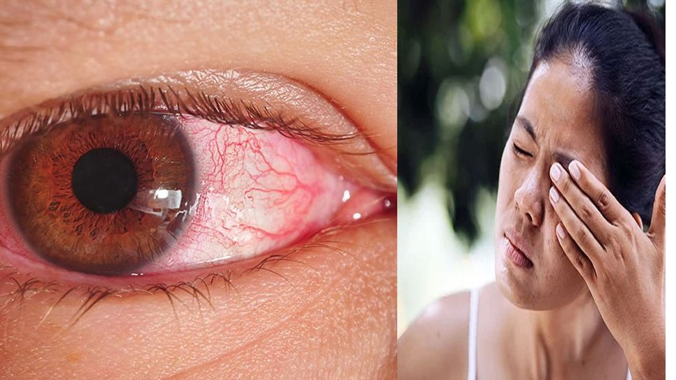 Burning Eyes Red eyes and burning have made you sad, these home