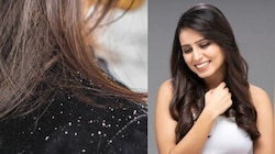 Dandruff Treatment: ಡ್ಯಾಂಡ್ರಫ್ ಸಮಸ್ಯೆಗೆ ಕೇವಲ 10 ರೂ.ಗಳಲ್ಲಿ ಪಡೆಯಿರಿ ಪರಿಹಾರ 