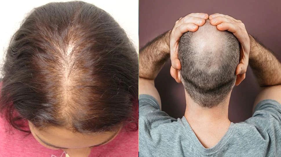 Easy solution for hair fall problem ಹೇರ್ ಫಾಲ್ ಸಮಸ್ಯೆಗೆ ಸುಲಭ ಪರಿಹಾರ