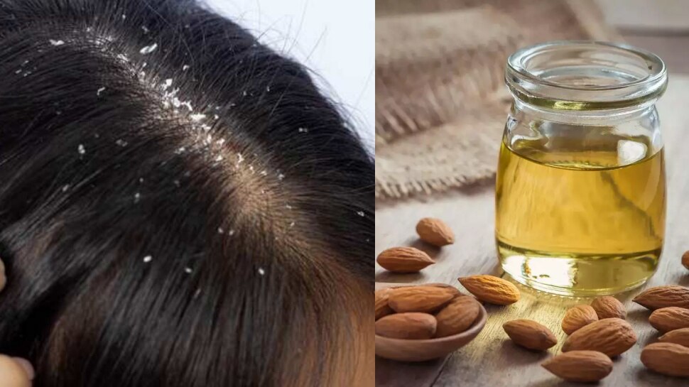 Almond oil Mixed with Lemon Juice or Honey can remove Dandruff