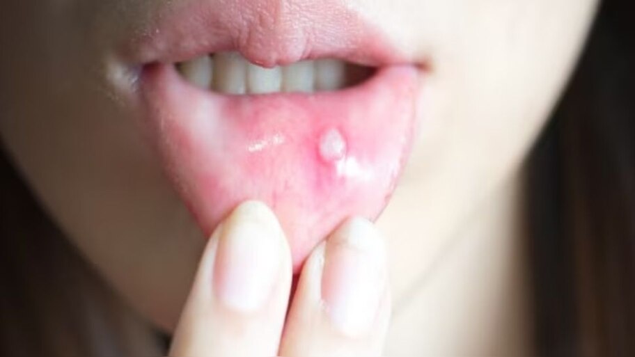 Do you also suffer from frequent mouth ulcers- This could also be the ...