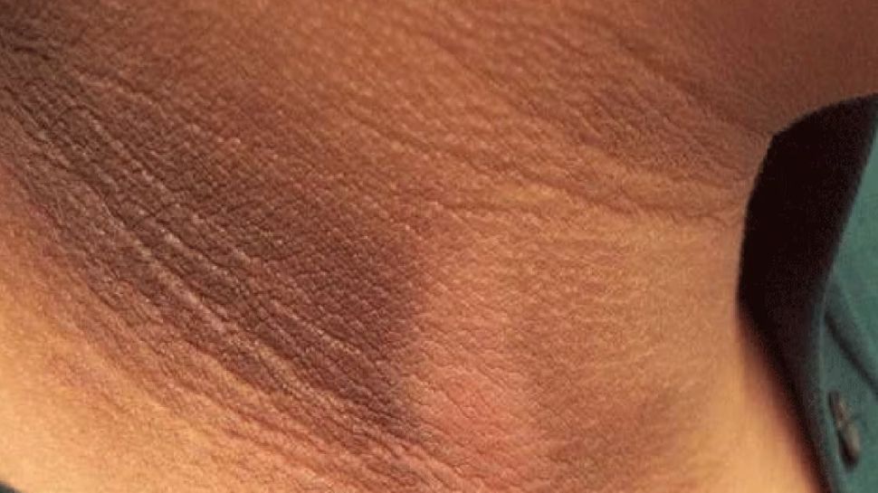 Neck Changing Color Treatment For Dark Neck: These of your mistakes may cause of Darkening ...