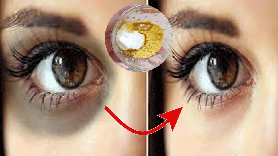 Home remedies to remove Dark circles in one week ಡಾರ್ಕ್ ಸರ್ಕಲ್