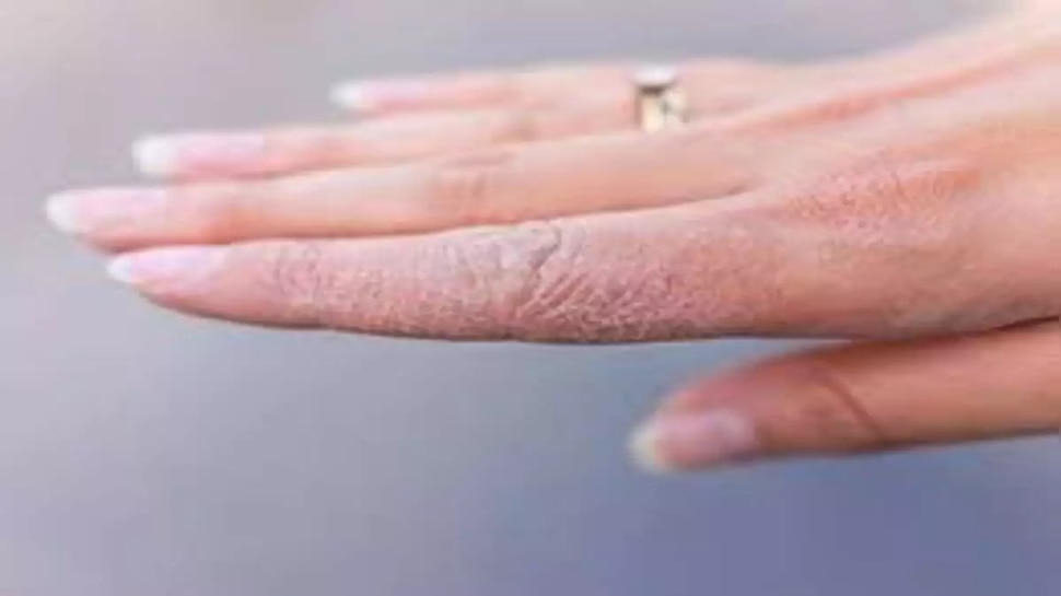 health-tips-what-causes-skin-peeling-on-hands-and-fingers-health