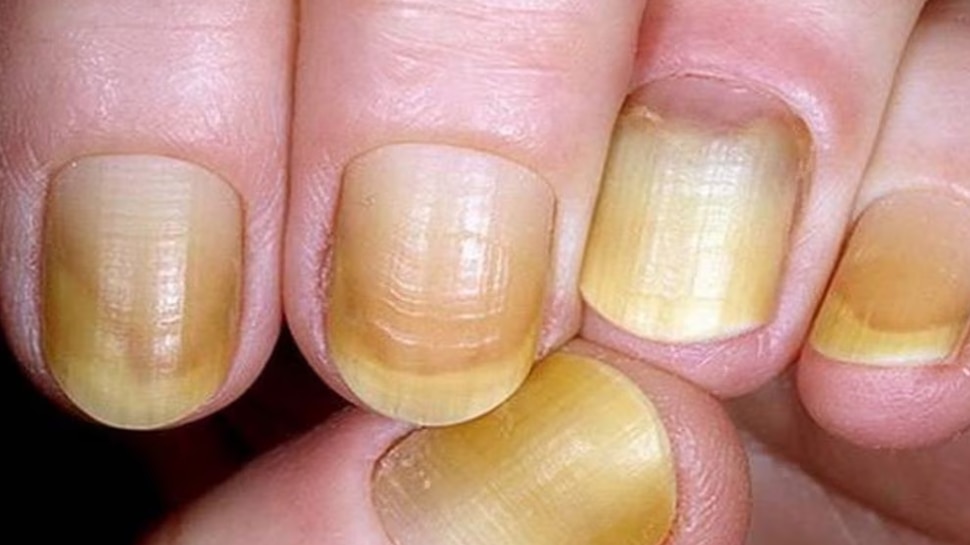 Are your fingernails turning yellow?..if so here is an easy solution ...