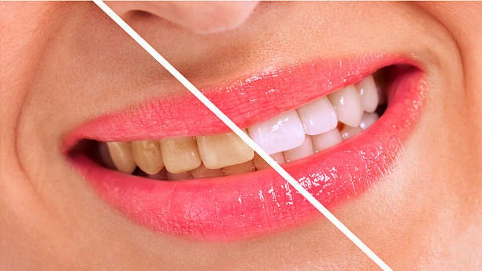 Best home remedies For Teeth Whitening ಹಲ್ಲುಗಳ ಮೇಲಿನ ಕೊಳಕು ಹಳದಿ