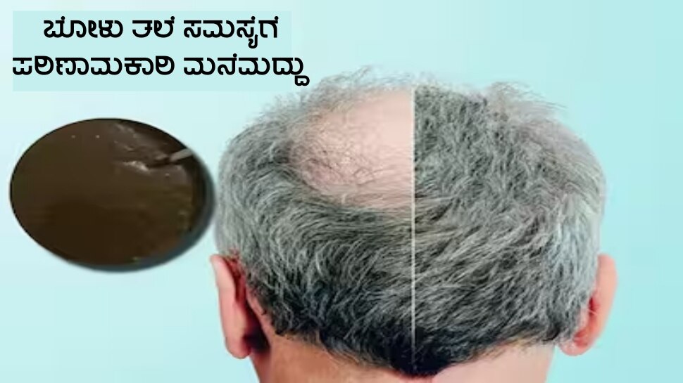 hair fall home remedies try this one remedy it will solve your baldness