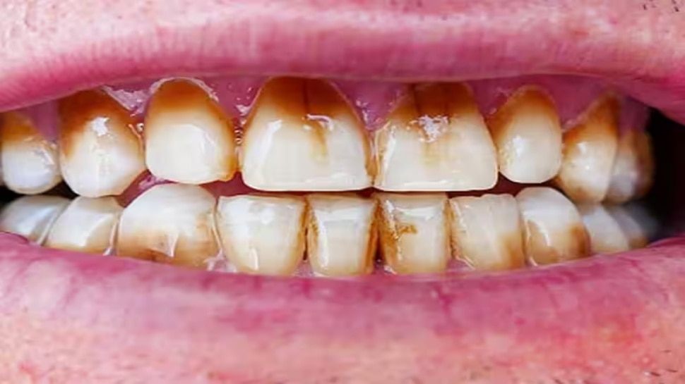 simple home remedies to get rid of plaque on teeth ಹಳದಿ ಹಲ್ಲುಗಳನ್ನು