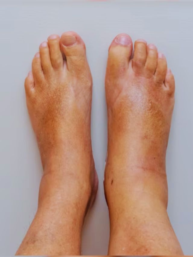 Best home remedy to reduce swelling in feet ಪಾದಗಳಲ್ಲಿ ಊತವನ್ನು ಕಡಿಮೆ