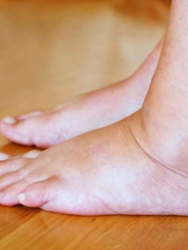 Best home remedy to reduce swelling in feet ಪಾದಗಳಲ್ಲಿ ಊತವನ್ನು ಕಡಿಮೆ
