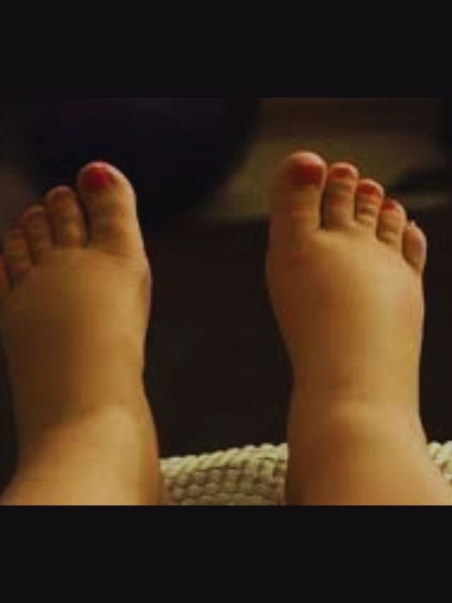 Best home remedy to reduce swelling in feet ಪಾದಗಳಲ್ಲಿ ಊತವನ್ನು ಕಡಿಮೆ
