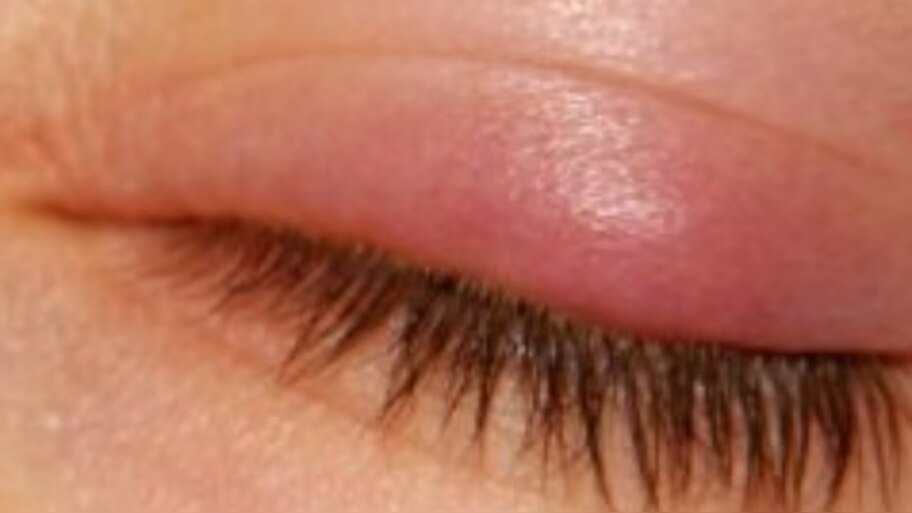 How you can find a solution for Stye on the eyes...! | ಕಣ್ಣಿನ ಮೇಲಿನ ...