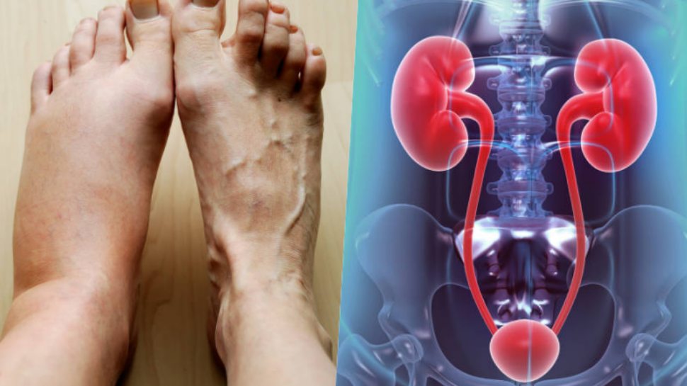 Swelling in the feet is Kidney Failure Symptoms ಕಿಡ್ನಿ ವೈಫಲ್ಯದ