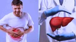 Fatty Liver: ಫ್ಯಾಟಿ ಲಿವರ್ ಎಂದರೇನು? ಕಾರಣಗಳು, ಲಕ್ಷಣಗಳು & ಚಿಕಿತ್ಸೆ