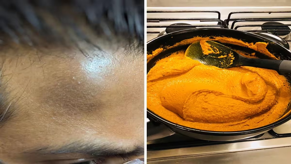 You can get rid of dark spots on your forehead with these home remedies ...