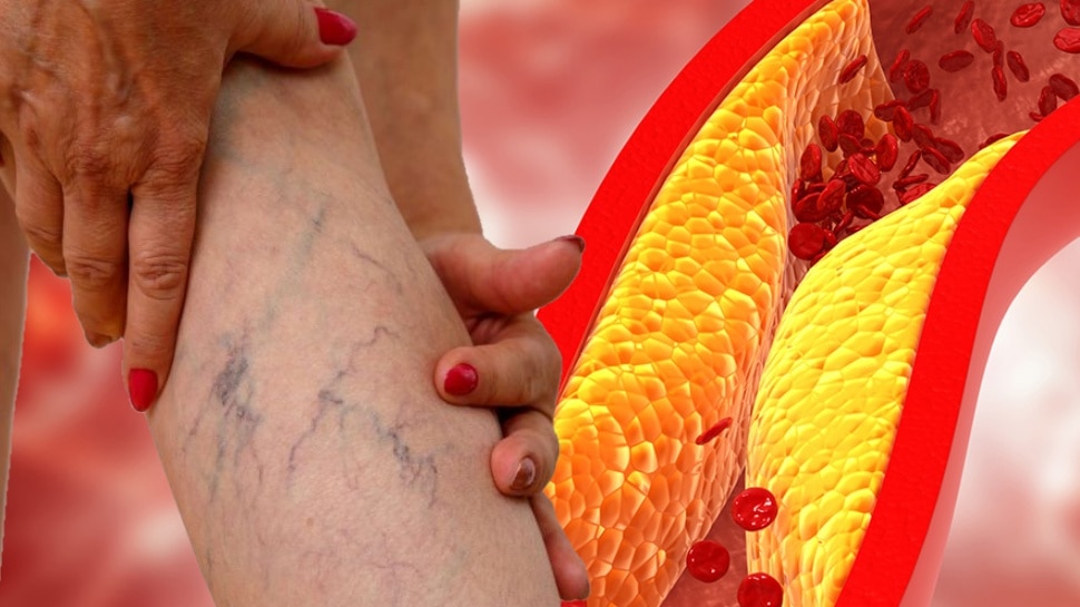 ಕಾಲಿನಲ್ಲಿ ಕಾಣಿಸಿಕೊಳ್ಳುವ ಇಂಥ ಬದಲಾವಣೆ ಈ ರೋಗದ ಪ್ರಮುಖ ಲಕ್ಷಣ.. ಅಪ್ಪಿತಪ್ಪಿ ನಿರ್ಲಕ್ಷಿಸಿದರೂ ಹಾರ್ಟ್‌ ಅಟ್ಯಾಕ್‌ ಆಗಬಹುದು!!