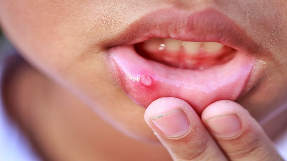 Mouth ulcers may be a sign of these 5 serious health problems |ಬಾಯಿ ...