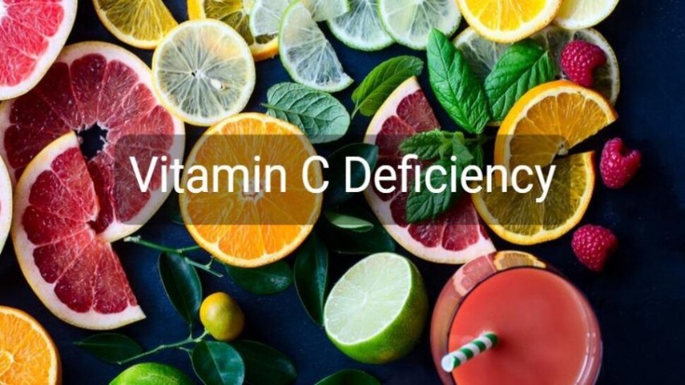 ವಿಟಮಿನ್ ಸಿ ಕೊರತೆಯಾದರೆ ದೇಹದ ಈ ಭಾಗದಲ್ಲಿ ಕಾಣಿಸಿಕೊಳ್ಳುತ್ತದೆ ವಿಪರೀತ ನೋವು !  