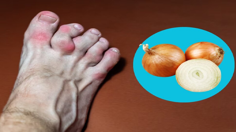 ಯೂರಿಕ್‌ ಆಸಿಡ್‌ಗೆ ಏಕೈಕ ಮದ್ದು ಈರುಳ್ಳಿ! ಹೀಗೆ ಬಳಸಿದ್ರೆ ಮತ್ತೆಂದೂ ಆ ಸಮಸ್ಯೆ ಕಾಡಲ್ಲ..