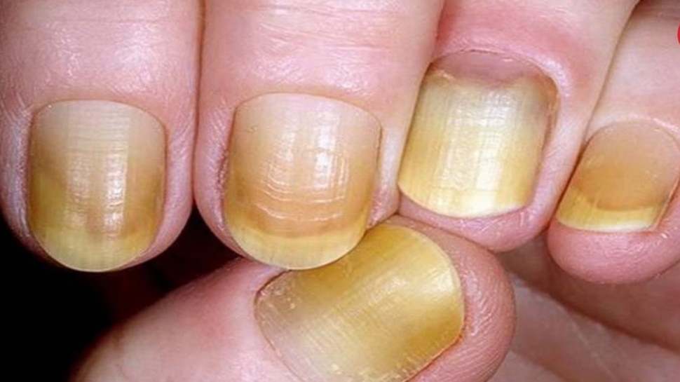 ಉಗುರು ಹೇಳುತ್ತದೆ ನಿಮಗೆ ಯಾವ ಕಾಯಿಲೆ ಇದೆ ಎನ್ನುವುದನ್ನು !ನಿಮ್ಮ ಉಗುರು ಕೂಡ ಹೀಗೆಯೇ ಇದೆಯಾ ಒಮ್ಮೆ ಚೆಕ್ ಮಾಡಿಕೊಳ್ಳಿ! 