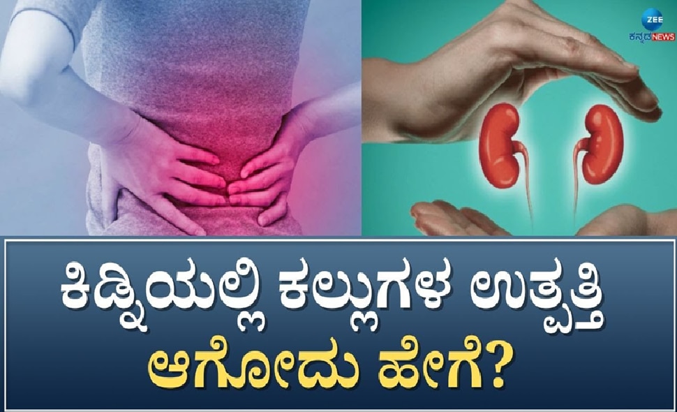 ಕಿಡ್ನಿ ಸ್ಟೋನ್‌ಗೆ ಕಾರಣವೇನು? ಈ ಗಂಭೀರ ಕಾಯಿಲೆಯಿಂದ ಪಾರಾಗುವುದು ಹೇಗೆ?