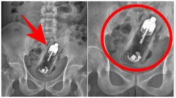 ಲೈಂಗಿಕ ತೃಪ್ತಿ ಹೊಂದಲು ಹೀಗೆಲ್ಲಾ ಮಾಡ್ತಾರಾ..? X-Ray ನೋಡಿ ವೈದ್ಯರೇ ಶಾಕ್‌..! ಯುವಕನ "ಗುದನಾಳ"ದಲ್ಲಿತ್ತು.. ಆ ದೊಡ್ಡ ವಸ್ತು..  