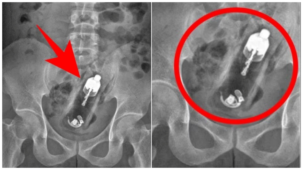 ಲೈಂಗಿಕ ತೃಪ್ತಿ ಹೊಂದಲು ಹೀಗೆಲ್ಲಾ ಮಾಡ್ತಾರಾ..? X-Ray ನೋಡಿ ವೈದ್ಯರೇ ಶಾಕ್..! ಯುವಕನ "ಗುದನಾಳ"ದಲ್ಲಿತ್ತು.. ಆ ದೊಡ್ಡ ವಸ್ತು.. ಲೈಂಗಿಕ ತೃಪ್ತಿ ಹೊಂದಲು ಹೀಗೆಲ್ಲಾ ಮಾಡ್ತಾರಾ..? X-Ray ನೋಡಿ ವೈದ್ಯರೇ ಶಾಕ್..! ಯುವಕನ "ಗುದನಾಳ"ದಲ್ಲಿತ್ತು.. ಆ ದೊಡ್ಡ ವಸ್ತು..