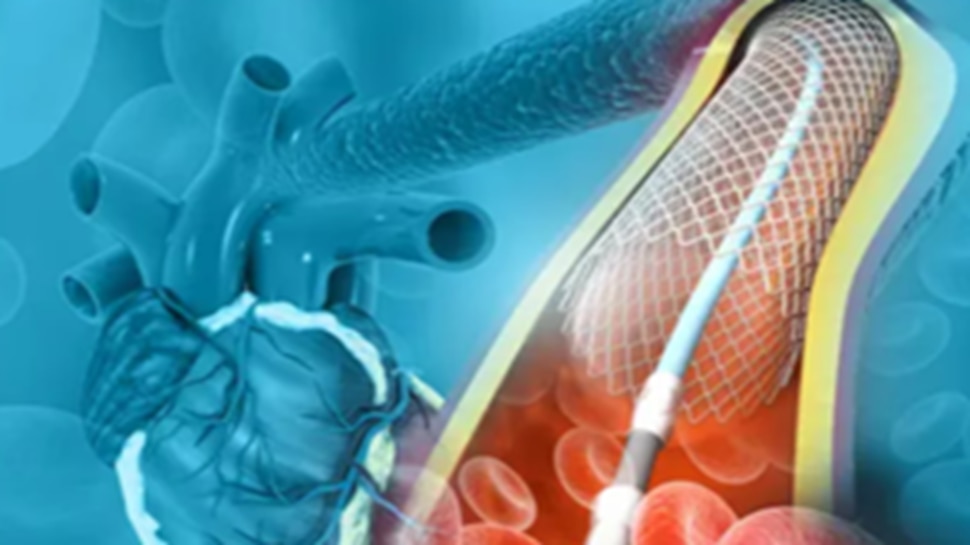 Keep an eye out for these symptoms otherwise you may need angioplasty ...
