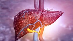 Fatty Liver: ಪ್ರತಿನಿತ್ಯ ಚಿಟಿಕೆಯಷ್ಟು ʻಈʼ ಪುಡಿಯನ್ನು ಬಾಯಿಗೆ ಹಾಕಿಕೊಂಡರೆ, ಯಾವುದೇ ಔಷಧಿ ಇಲ್ಲದೆ ಕಾಣೆಯಾಗುತ್ತೆ ಕೊಬ್ಬಿದ ಯಕೃತ್ತಿನ ಸಮಸ್ಯೆ!