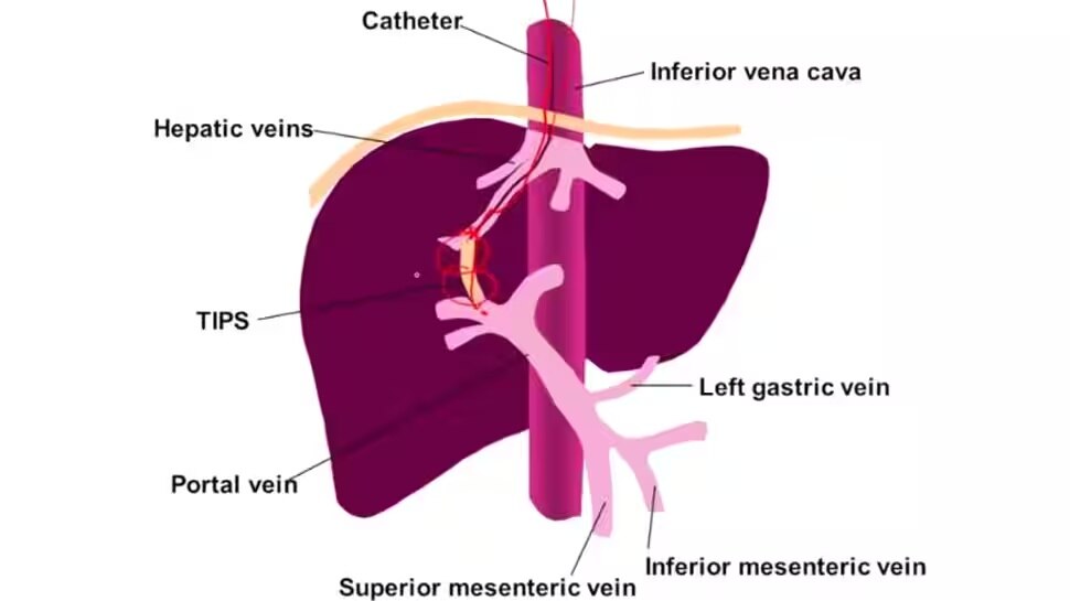  Food that id bad for liver 