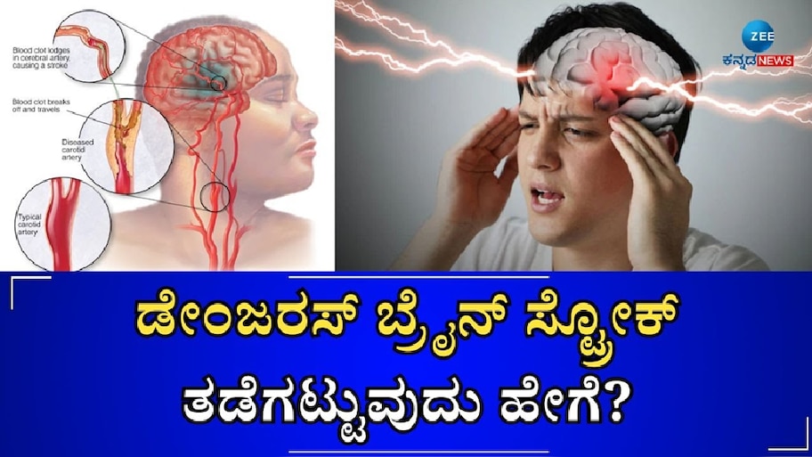 ಈ ರೀತಿಯ ಲಕ್ಷಣಗಳು ಕಂಡುಬಂದ್ರೆ ನಿಮಗೆ ಬ್ರೇನ್‌ ಸ್ಟ್ರೋಕ್‌ ಆಗುತ್ತೆ ಎಂದರ್ಥ: ಕೂಡಲೇ ಎಚ್ಚರವಹಿಸಿ