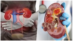 Kidney failure : ಕಿಡ್ನಿ ಫೆಲ್ಯೂರ್‌ಗೆ ಈ ರುಚಿಕರ ಆಹಾರಗಳೇ ಕಾರಣ..! ಮುಂದಿನ ಬಾರಿ ಇವುಗಳನ್ನ ತಿನ್ನುವು ಮುನ್ನ ಎಚ್ಚರ..