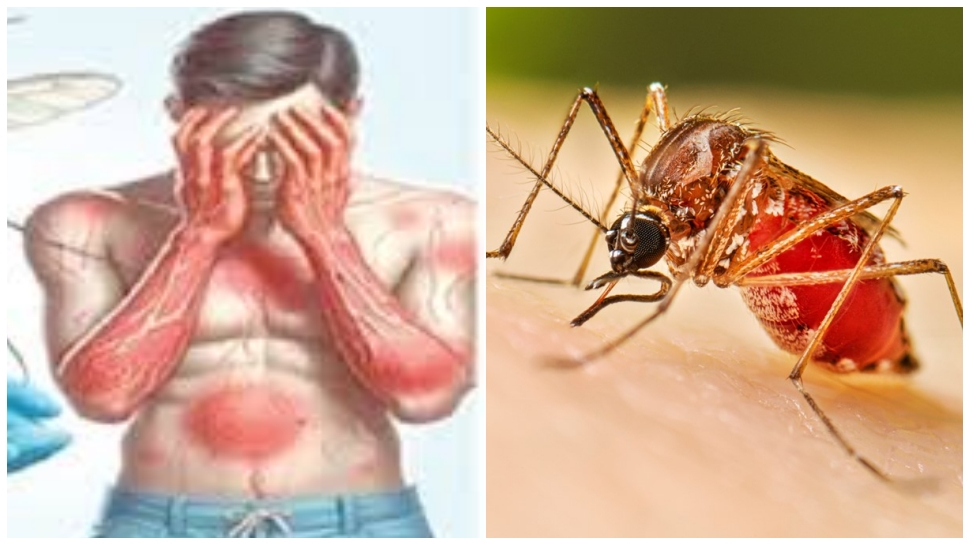 ಮಳೆಗಾಲದಲ್ಲಿಯೇ ಹೆಚ್ಚಾಗೋದು ಡೆಂಗ್ಯೂ ಸೊಳ್ಳೆಗಳ ಕಾಟ..! ದೇಹದಲ್ಲಿ ಈ ಲಕ್ಷಣಗಳು ಕಾಣಿಸಿಕೊಂಡರೆ ಜ್ವರ ಕನ್ಫರ್ಮ್ ಮಳೆಗಾಲದಲ್ಲಿಯೇ ಹೆಚ್ಚಾಗೋದು ಡೆಂಗ್ಯೂ ಸೊಳ್ಳೆಗಳ ಕಾಟ..! ದೇಹದಲ್ಲಿ ಈ ಲಕ್ಷಣಗಳು ಕಾಣಿಸಿಕೊಂಡರೆ ಜ್ವರ ಕನ್ಫರ್ಮ್