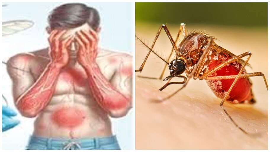 ಮಳೆಗಾಲದಲ್ಲಿಯೇ ಹೆಚ್ಚಾಗೋದು ಡೆಂಗ್ಯೂ ಸೊಳ್ಳೆಗಳ ಕಾಟ..! ದೇಹದಲ್ಲಿ ಈ ಲಕ್ಷಣಗಳು ಕಾಣಿಸಿಕೊಂಡರೆ ಜ್ವರ ಕನ್‌ಫರ್ಮ್