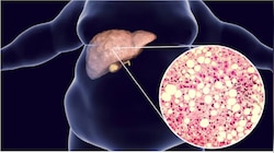 Fatty liver: ನಿಮಗೆ ಫ್ಯಾಟಿ ಲಿವರ್‌ ಇದ್ದರೆ ಆ ಮಾರಕ ಕ್ಯಾನ್ಸರ್‌ ಕಾಯಿಲೆ ಖಚಿತ