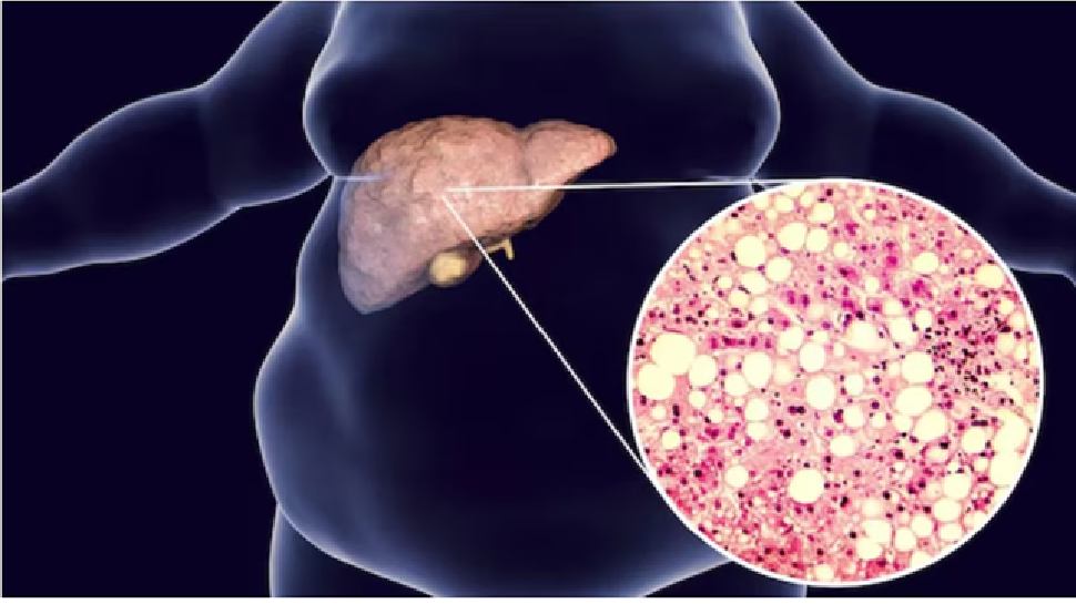 Fatty liver: ನಿಮಗೆ ಫ್ಯಾಟಿ ಲಿವರ್ ಇದ್ದರೆ ಆ ಮಾರಕ ಕ್ಯಾನ್ಸರ್ ಕಾಯಿಲೆ ಖಚಿತ Fatty liver: ನಿಮಗೆ ಫ್ಯಾಟಿ ಲಿವರ್ ಇದ್ದರೆ ಆ ಮಾರಕ ಕ್ಯಾನ್ಸರ್ ಕಾಯಿಲೆ ಖಚಿತ