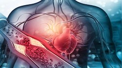 Heart attack: ಹೃದಯಾಘಾತವಾಗುವ ಮುನ್ನ ಚರ್ಮದಲ್ಲಿ ಈ ಲಕ್ಷಣಗಳು ಕಾಣಿಸಕೊಳ್ಳುತ್ತವೆ! ಈ ಮುನ್ಸೂಚನೆಗಳನ್ನು ಕಡೆಗಣಿಸಿದರಿ.. ಇಲ್ಲಾ ಅಂದ್ರೆ ಅಪಾಯ ಖಚಿತ