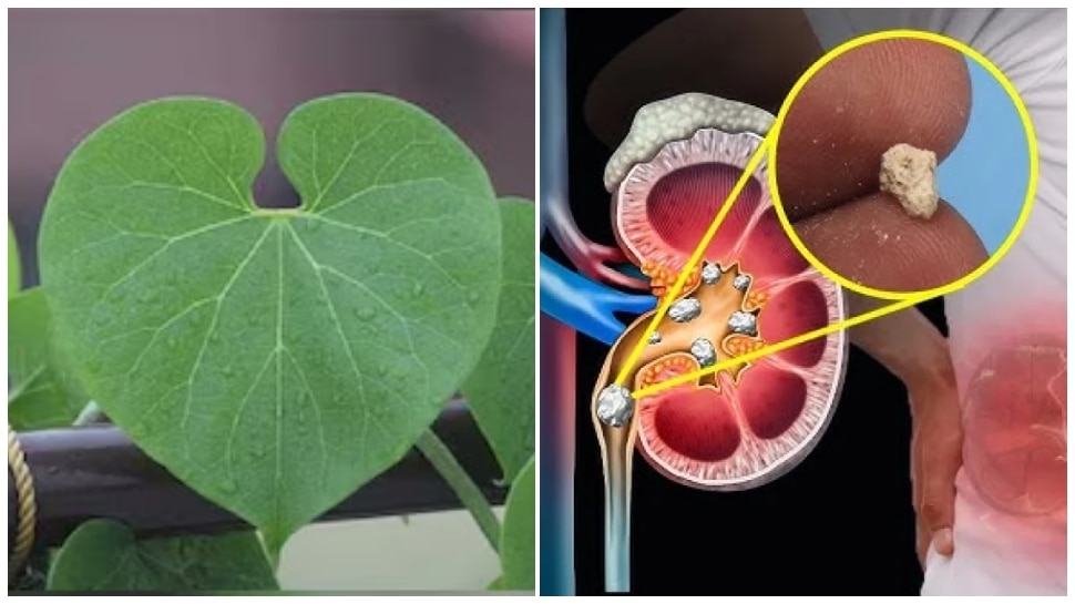 ದಾರಿ ಬದಿಯಲ್ಲಿ ಸಿಗುವ ಈ ಎಲೆ ಕಿಡ್ನಿ ಸ್ಟೋನ್‌ಗೆ ರಾಮಬಾಣ.! ಮೂತ್ರಪಿಂಡದ ಕಲ್ಲಿನ ಸಮಸ್ಯೆಗೆ ಇದೇ ಅಮೃತ 