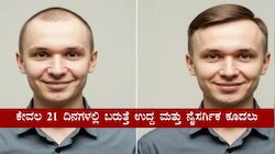 ಬೋಳು ತಲೆ ಬಗ್ಗೆ ಚಿಂತೆ ಬೇಡ, ಕೊನೆಗೂ ಬಂತು ಔಷಧಿ.! ಕೇವಲ 21 ದಿನಗಳಲ್ಲಿ ಬರುತ್ತೆ ಉದ್ದ ಮತ್ತು ನೈಸರ್ಗಿಕ ಕೂದಲು 