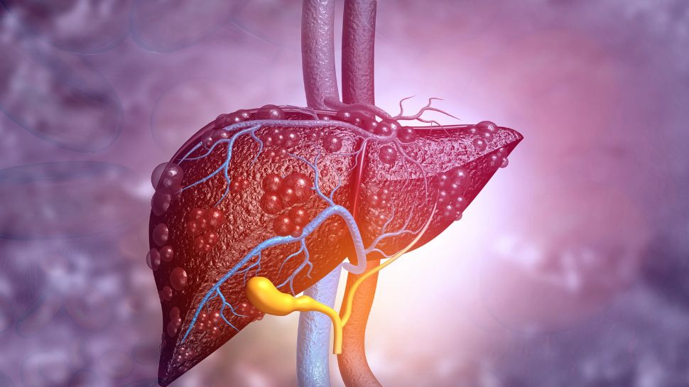 ಮೈ ಬಣ್ಣ ಹೀಗಾಗಿದ್ದರೇ ಖಂಡಿತ ಲಿವರ್‌ ಡ್ಯಾಮೆಜ್‌ ಆಗಿದೆಯೇ ಎಂದರ್ಥ! ತಪ್ಪಿಯೂ ನಿರ್ಲಕ್ಷಿಸಬೇಡಿ..