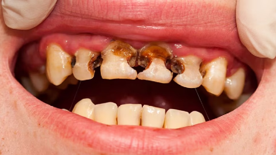 Instant Relief from Toothache! Effective Home Remedies to Reduce ...