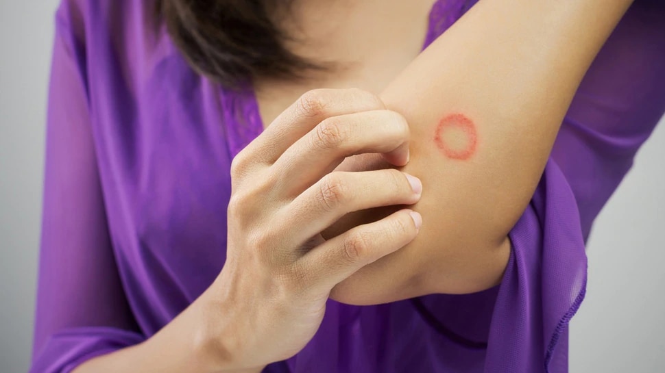 ringworm treatments cure ringworm at home itching neem leaves coconut