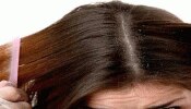 Hair Care Tips: ತಲೆಹೊಟ್ಟಿನಿಂದ ಕೂದಲು ಹಾಳಾಗಿದೆಯೇ? ತ್ವರಿತ ಪರಿಹಾರಕ್ಕಾಗಿ ಈ 5 ಮನೆಮದ್ದನ್ನು ಟ್ರೈ ಮಾಡಿ