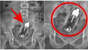 ಲೈಂಗಿಕ ತೃಪ್ತಿ ಹೊಂದಲು ಹೀಗೆಲ್ಲಾ ಮಾಡ್ತಾರಾ..? X-Ray ನೋಡಿ ವೈದ್ಯರೇ ಶಾಕ್‌..! ಯುವಕನ &quot;ಗುದನಾಳ&quot;ದಲ್ಲಿತ್ತು.. ಆ ದೊಡ್ಡ ವಸ್ತು..  