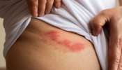 ಮಧುಮೇಹಿಗಳಿಗೆ ಹೆಚ್ಚಾಗಿ ಕಾಣಿಸಿಕೊಳ್ಳುವ ಈ ಅಪಾಯಕಾರಿ ಚರ್ಮದ ಸಮಸ್ಯೆ! ರಕ್ತದ ಸೊಂಕನ್ನು ನಿರ್ಲಕ್ಷ್ಯಿಸಿದರೆ ಅಪಾಯ ಖಚಿತ