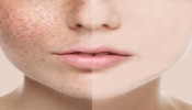 ಈ ಸೀರಮ್‌ ಬಳಸಿದ್ರೆ ಒಂದೆರಡು ದಿನಗಳಲ್ಲೇ ಮೊಡವೆಗಳು ಮಾಯ: ನಿಮ್ಮ ಮುಖ ಫಳ ಫಳ ಹೊಳೆಯುತ್ತೆ